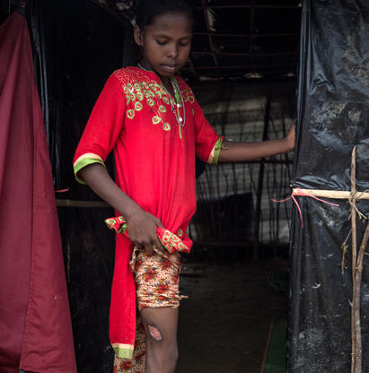 Jente på 12 år viser frem et skuddsår hun fikk da hun løp fra soldater i Myanmar.